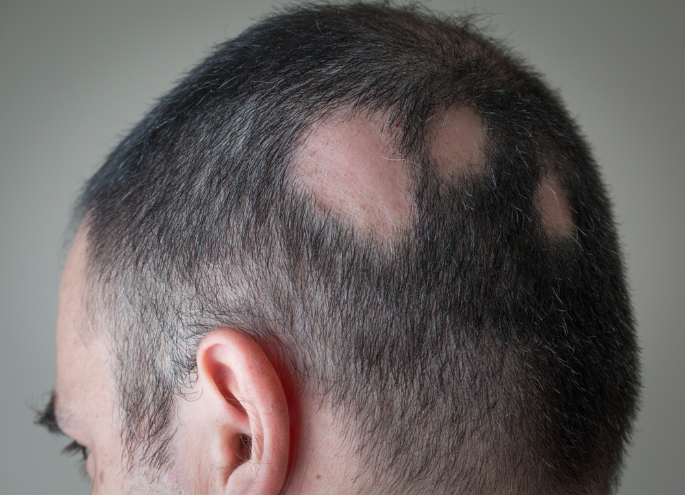 ilustrasi alopecia aerata | Alex Papp/Shutterstock