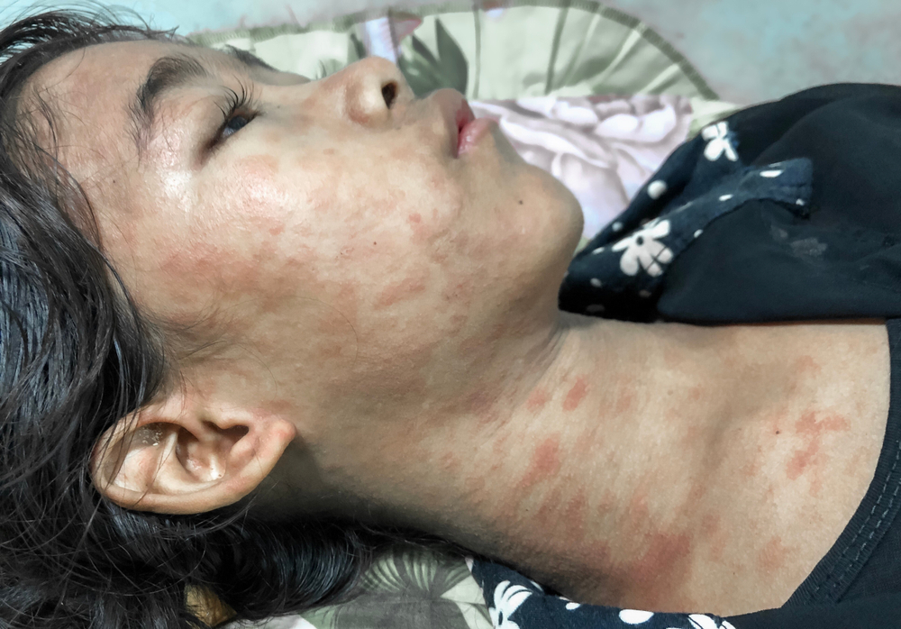 Bintik merah gejala chikungunya dan DBD | Zay Nyi Nyi/Shutterstock