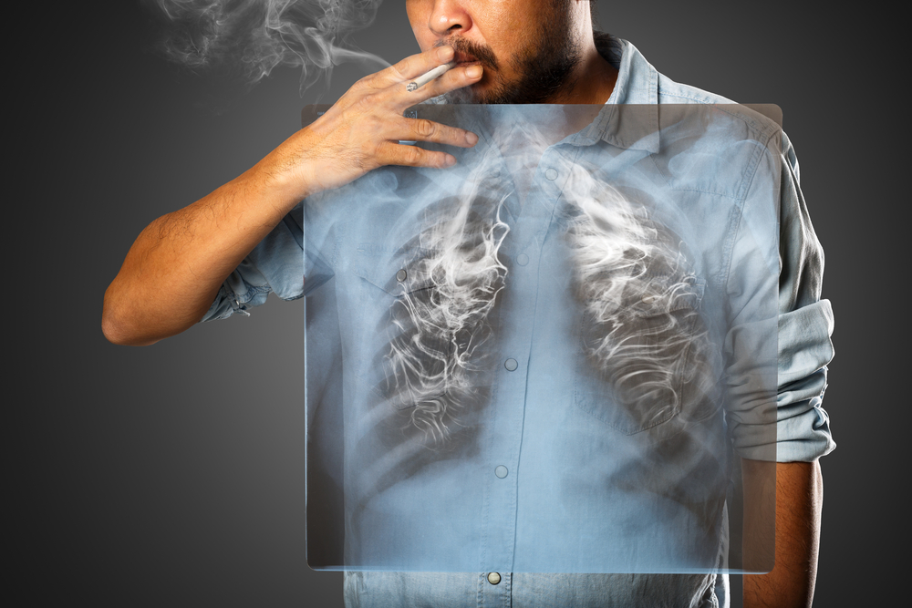 Ilustrasi merokok yang dapat menyebabkan kanker paru | Krunja/Shutterstock