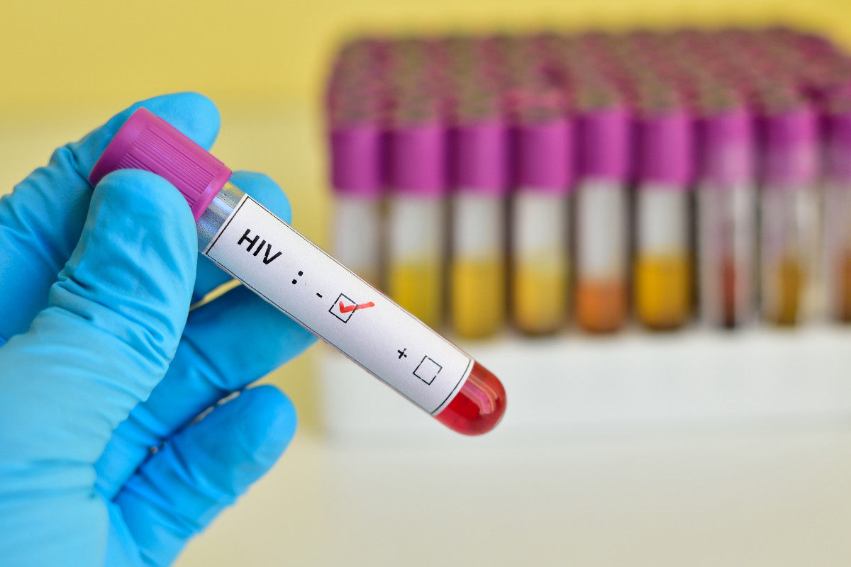 Riwayat Kesembuhan Pasien HIV yang Baru Terjadi 4 Kali di Dunia